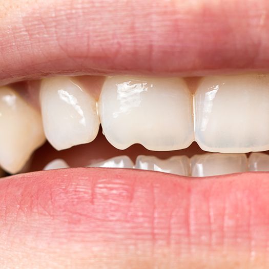 Close-up of person’s chipped front tooth