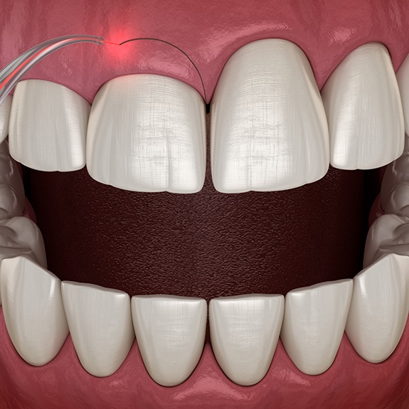 Illustration of laser being used to perform gum recontouring