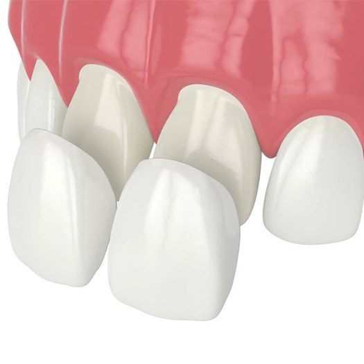 Illustration of veneers being placed on front teeth