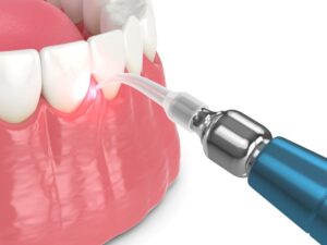 Illustration of dental laser being used during gum recontouring